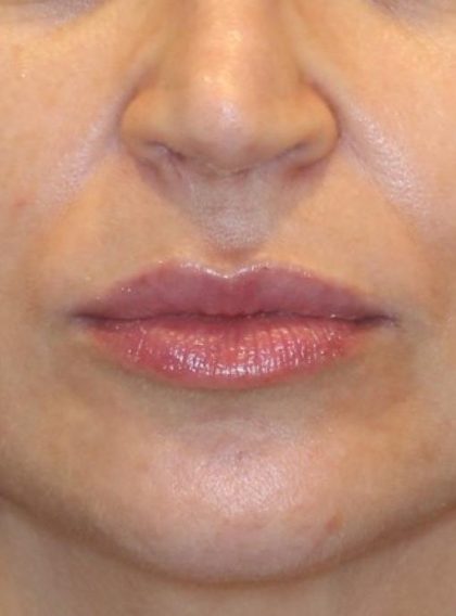 Lip Filler Before & After Patient #13836