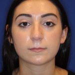 Lip Filler Before & After Patient #13835
