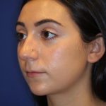 Lip Filler Before & After Patient #13835