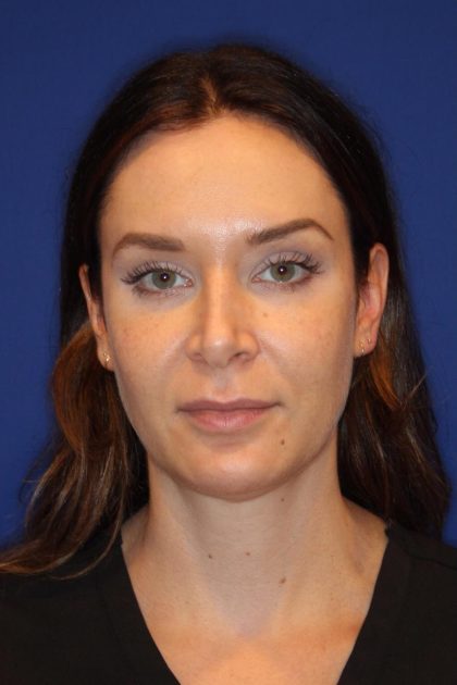 Lip Filler Before & After Patient #13832