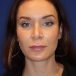 Lip Filler Before & After Patient #13832
