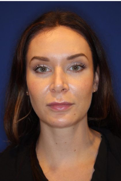 Lip Filler Before & After Patient #13832