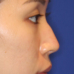 Non-Surgical Nose Job Before & After Patient #13883