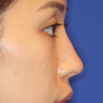 Non-Surgical Nose Job Before & After Patient #13883