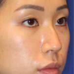 Non-Surgical Nose Job Before & After Patient #13883