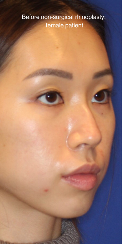 Non-Surgical Nose Job Before & After Patient #13883