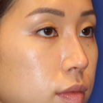 Non-Surgical Nose Job Before & After Patient #13883