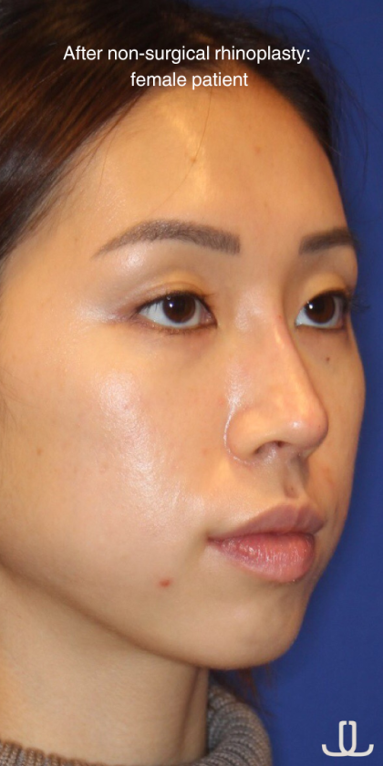 Non-Surgical Nose Job Before & After Patient #13883