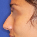 Non-Surgical Nose Job Before & After Patient #15844