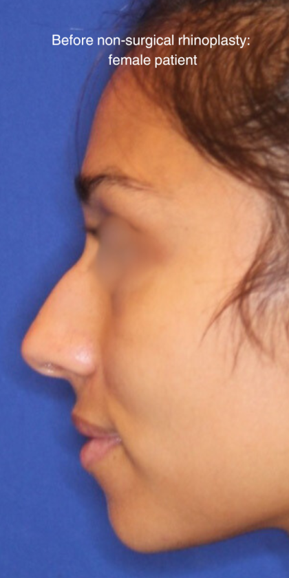 Non-Surgical Nose Job Before & After Patient #15844