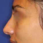 Non-Surgical Nose Job Before & After Patient #15844