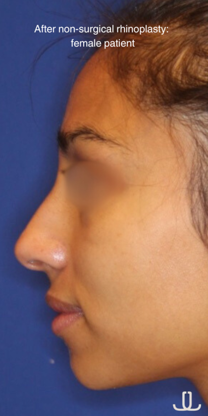 Non-Surgical Nose Job Before & After Patient #15844