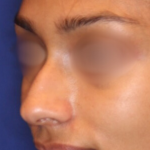 Non-Surgical Nose Job Before & After Patient #15844