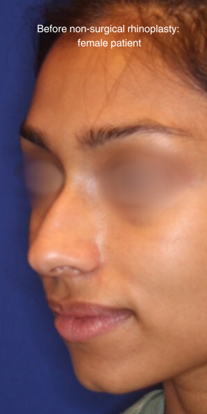 Non-Surgical Nose Job Before & After Patient #15844