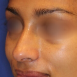 Non-Surgical Nose Job Before & After Patient #15844