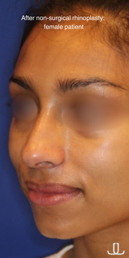 Non-Surgical Nose Job Before & After Patient #15844