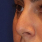 Non-Surgical Nose Job Before & After Patient #13889