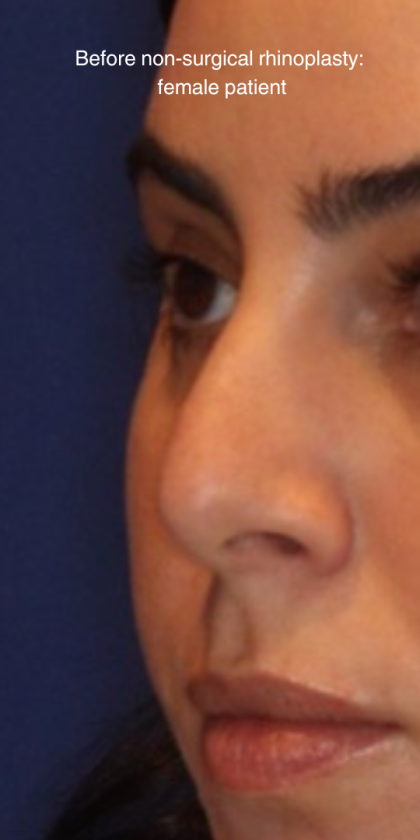 Non-Surgical Nose Job Before & After Patient #13889