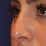 Non-Surgical Nose Job Before & After Patient #13889