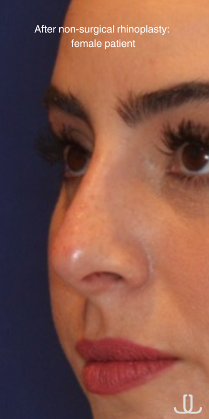 Non-Surgical Nose Job Before & After Patient #13889