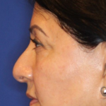 Non-Surgical Nose Job Before & After Patient #13886