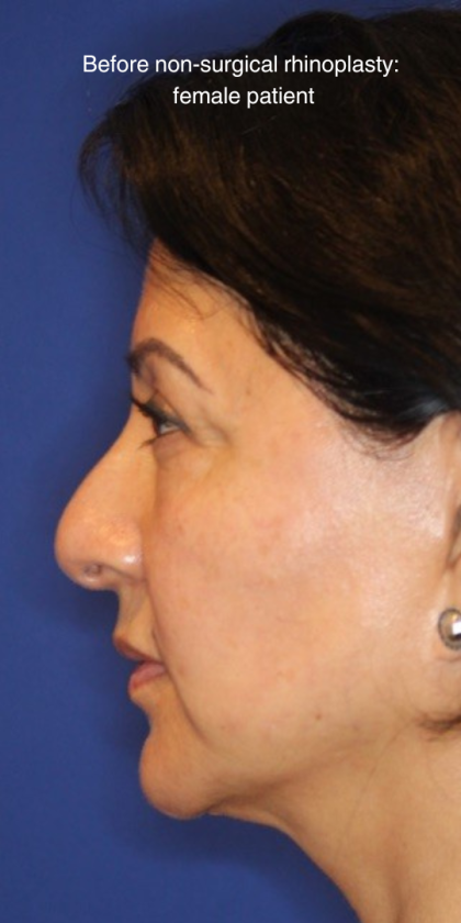 Non-Surgical Nose Job Before & After Patient #13886