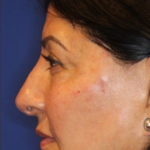 Non-Surgical Nose Job Before & After Patient #13886