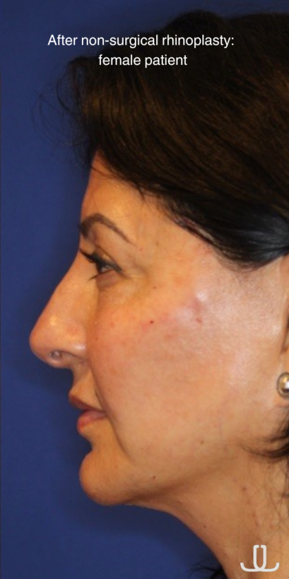 Non-Surgical Nose Job Before & After Patient #13886