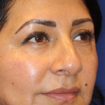 Non-Surgical Nose Job Before & After Patient #13886