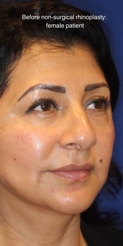 Non-Surgical Nose Job Before & After Patient #13886