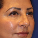 Non-Surgical Nose Job Before & After Patient #13886