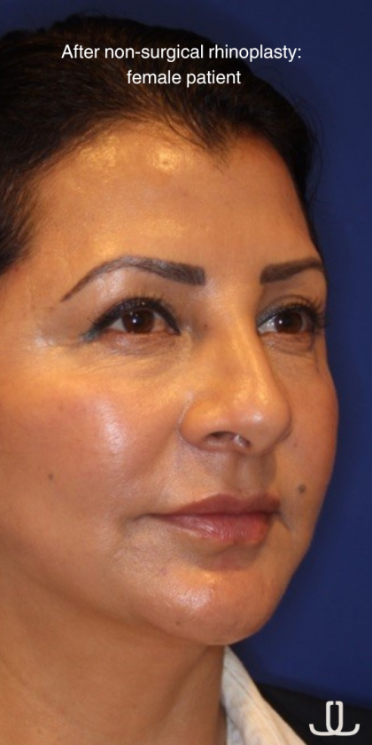 Non-Surgical Nose Job Before & After Patient #13886