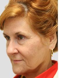 Otoplasty Before & After Patient #13912