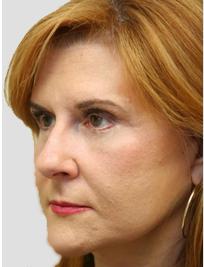 Otoplasty Before & After Patient #13912