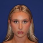 Volux Before & After Patient #13910