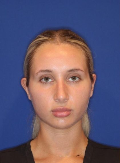Volux Before & After Patient #13910