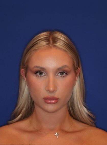 Volux Before & After Patient #13910