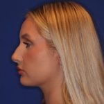 Volux Before & After Patient #13910