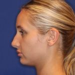 Volux Before & After Patient #13910