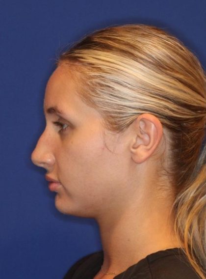 Volux Before & After Patient #13910