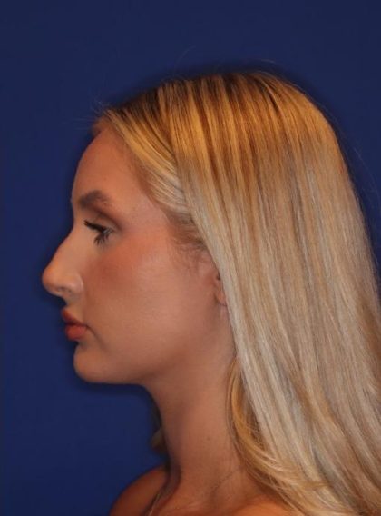 Volux Before & After Patient #13910