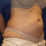Body Contouring Before & After Patient #14232
