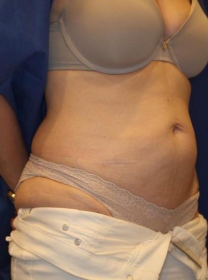Body Contouring Before & After Patient #14232