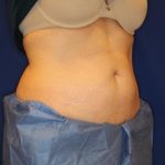Body Contouring Before & After Patient #14232