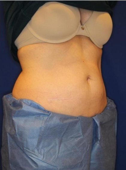 Body Contouring Before & After Patient #14232