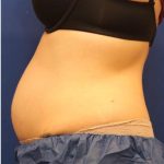 Body Contouring Before & After Patient #14233
