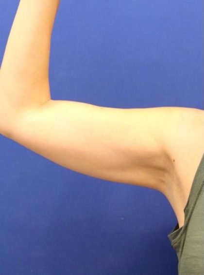 Body Contouring Before & After Patient #14234