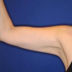 Body Contouring Before & After Patient #14234