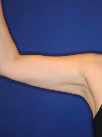 Body Contouring Before & After Patient #14234