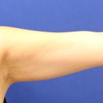Body Contouring Before & After Patient #14234
